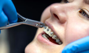 Perbedaan Aligner Dan Behel