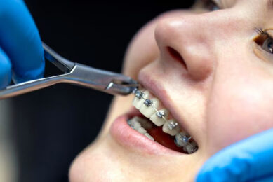 Perbedaan Aligner Dan Behel
